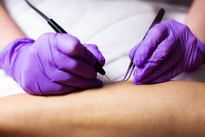 Hair removal salon in Shropshire